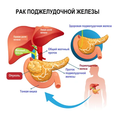 Что вредно для поджелудочной железы