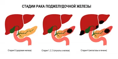 Какие стадии и разновидности рака поджелудочной железы? - Hisar  Intercontinental Hospital