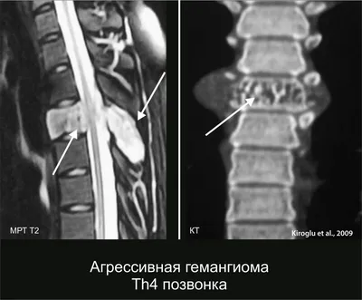 Удаление гемангиомы лазером: цены в Москве | Стоимость лазерного удаления  гемангиом в клинике BeautyWay Clinic