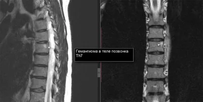 Гемангиома, микрогематома на коже человека, крупный план, заболевания  стоковое фото ©Genrix20061.mail.ru 231944668