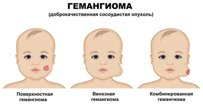 Что такое гемангиома? Описание и особенности болезни.