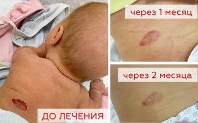 Гемангиома, Microhematoma на человеческой коже, конец-вверх, заболевание  Стоковое Изображение - изображение насчитывающей пигмент, внимательность:  134438151