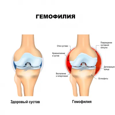 Гемофилия - причины появления, симптомы заболевания, диагностика и способы  лечения