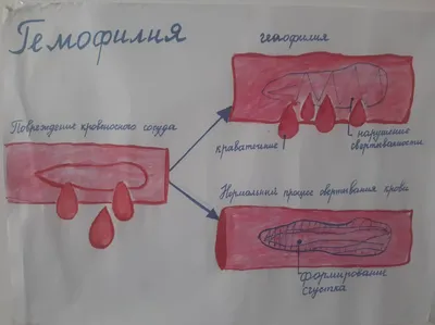 Лечение гемофилии фактором свёртывания крови VIII | Пикабу