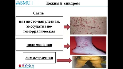 Геморрагический васкулит: что необходимо знать - Педіатр цілодобово:  Люботин, Харків, область