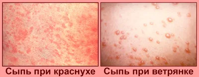 Аллергическая сыпь на коже. Женщина с проблемой дерматологии на коже  Стоковое Изображение - изображение насчитывающей персона, аллергически:  195546921