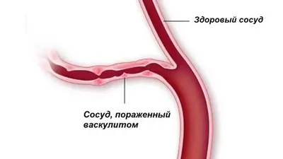 Что такое васкулит и как его лечить в домашних условиях | «Центр Болотова»