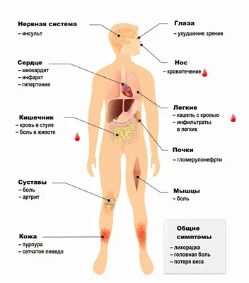 Васкулит: классификация, диагностика, симптомы, лечение у взрослых