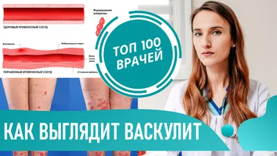 Геморрагический васкулит у детей | Дипломная Педиатрия | Docsity