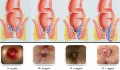Геморрой: причины, симптомы, стадии, виды, осложнения, профилактика
