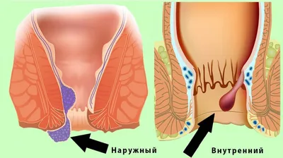 Геморроидальные узлы фото