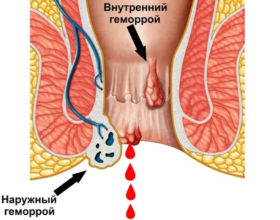 Дезартеризация геморроидальных узлов в Нижнем Новгороде | Онли Клиник