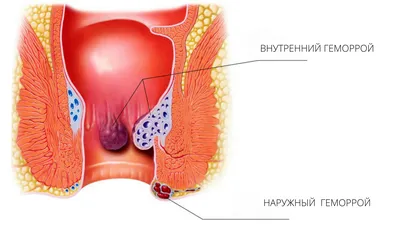 Геморрой: лечение, симптомы, причины, виды профилактика, последствия и  диагностика заболевания