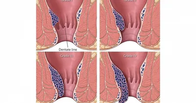 Геморрой как он есть и как его лечить, чтобы не было мучительно больно
