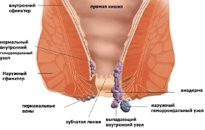 Геморрой — (клиники Di Центр)