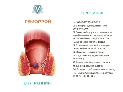 Причины возникновения геморроя, способы лечения гемороя