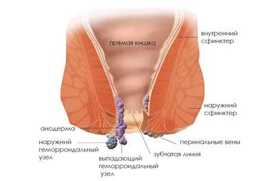 геморрой | МЦ Фемина и Эскулап Рыбинск