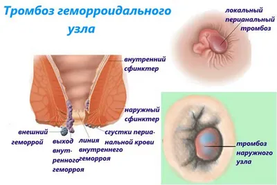 Внутренние геморроидальные узлы - лечение выпадения геморроя