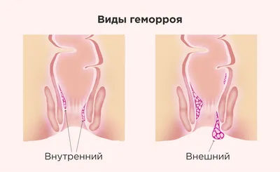 Геморрой: что такое? Как бороться? - статьи от компании Еламед