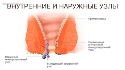 Эффективное лечение геморроя в Ростове-на-Дону