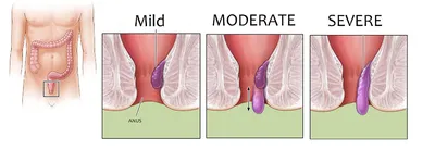 Эффективное лечение внутреннего геморроя - блог Виртус