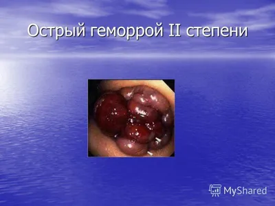 Геморрой - симптомы, лечение, причины и профилактика геморроя - Гармония