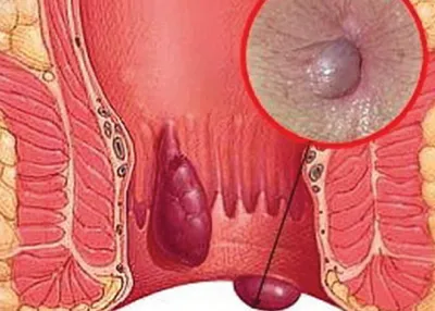 Наружный геморрой: симптомы, диагностика, лечение - Клиника Доктора Гришина