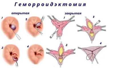 Геморрой: симптомы, причины, наружный и внутренний, стоимость лечения и  операции