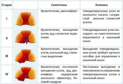 Мрия медицинский центр - Тромбоз геморроидальных узлов — одно из самых  серьезных осложнений геморроя. В геморроидальных узлах происходит застой  крови, которая сворачивается и образует тромбы, закупоривающие геморроидальные  узлы. Острый тромбированный ...