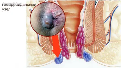 Геморрой — симптомы и лечение геморроя