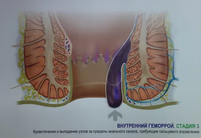 Геморроидальные узлы: классификация и лечение