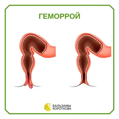 Геморрой у женщин: что делать, чтобы вылечиться