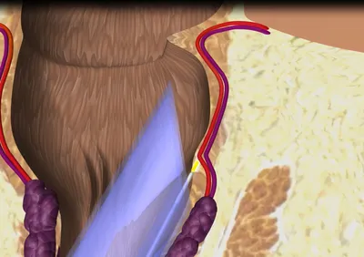 Геморроидальный тромбоз или «шишка» в области ануса - KP.RU