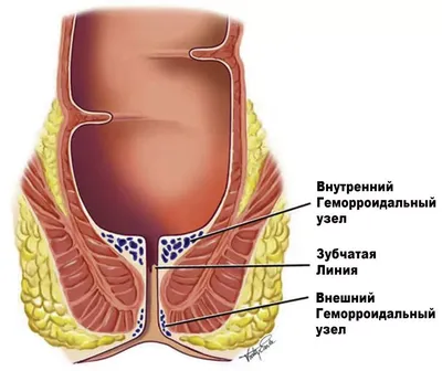 Геморрой, геморроидальные узлы операции в Ульяновске. — Многопрофильная  клиника Н.Березиной Ульяновск