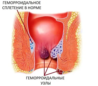 Геморрой — самое распространенное колопроктологическое заболевание