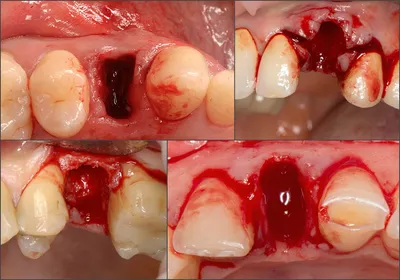Операция Удаления Зуба-Местные Осложнения После Удаления Зуба