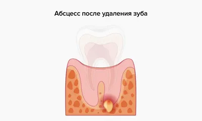 Удаление зуба: как это делается? / Хабр