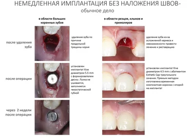 Удаление коренных зубов: виды удаления, как проводится процедура