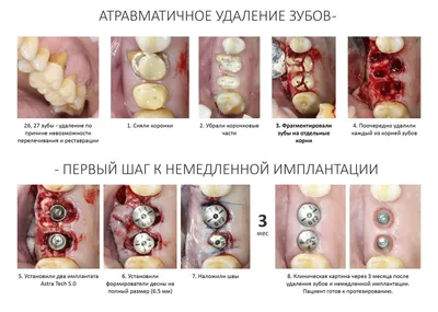 Простое удаление зуба за 10 шагов — CLINICIN.RU