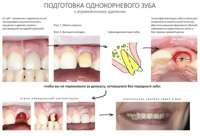 Не усложняйте! Немедленная имплантация или аугментация лунки? —  IMPLANT-IN.COM — дентальная имплантация. естественно.