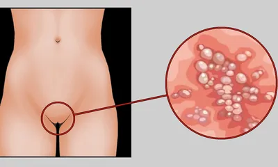 Генитальный герпес – симптомы, причины, диагностика и лечение у женщин и  мужчин в клинике «Будь Здоров»