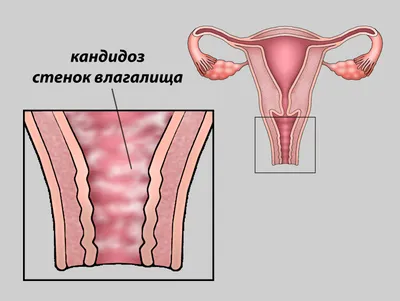 Лечение кандидоза в Новосибирске. Низкие цены! | МЦ \"Альфа Технологии\"