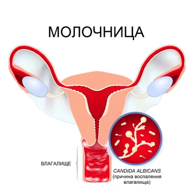 Молочница, кандидоз генитальный (фитокомплекс) / фитомагазин \"Мариславна\"
