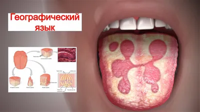 Географический язык - причины, этиология, виды, симптомы, диагностика,  лечение