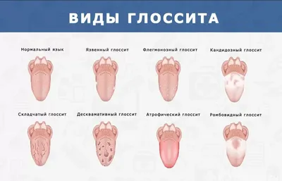 Рис. 4. Больной Ю., 27 лет. Исход синдрома Лайелла. «Географический» …