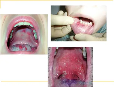 ОРВИ: боль в горле, красное горло, антисептики, герпангина | ВКонтакте