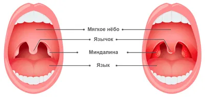 Расскажите о кори и как отличить от герпангины?: malyshi — LiveJournal