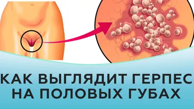 Герпес — симптомы и лечение | Блог Daily Medical