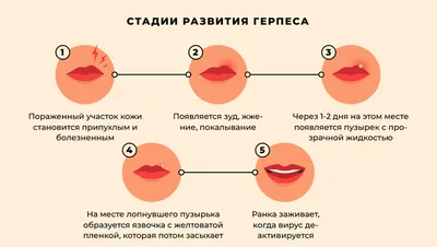 Герпес — симптомы и лечение | Блог Daily Medical