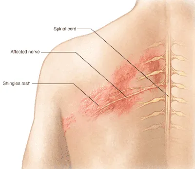 Опоясывающий лишай (герпес): лечение, симптомы с фото, причины
